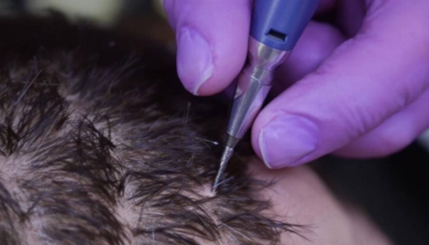 Avantages de la technique FUE avec micro-saphir pour la densité capillaire